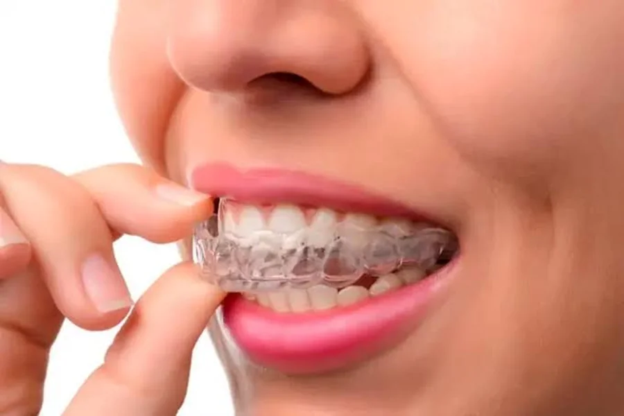 Traditional Braces